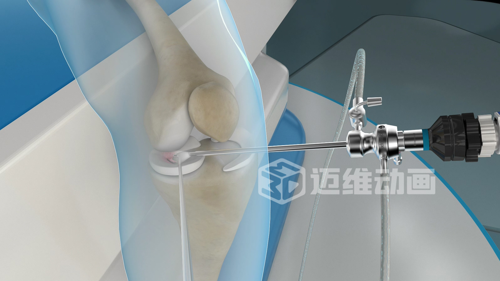 關節(jié)鏡手術三維動畫